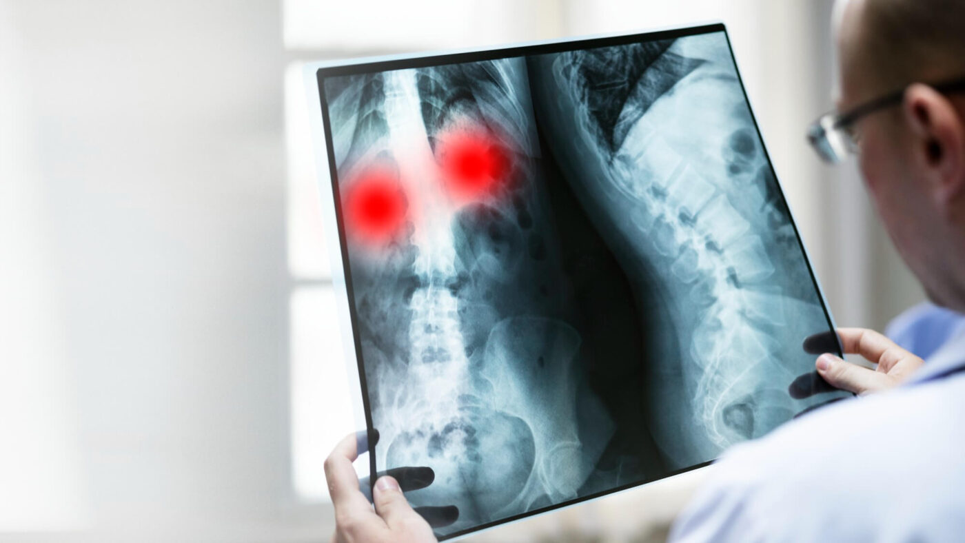 Ce trebuie să știm despre răspândirea cancerului (metastaze) – explicat simplu