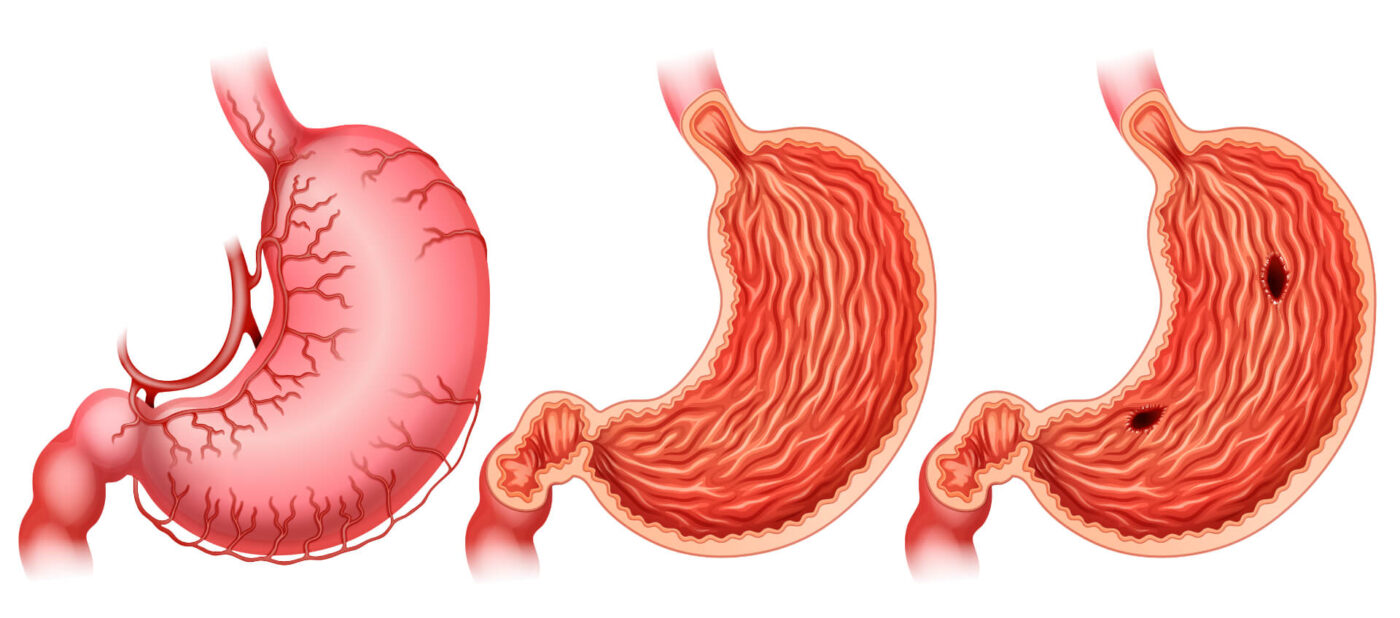 Ce au descoperit cercetătorii despre cancerul gastric și gene?