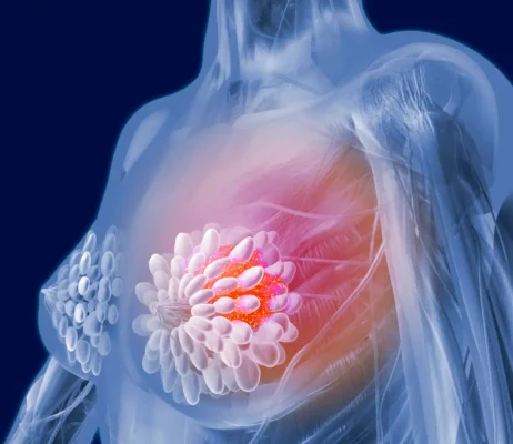 inteligenta artificiala in ajutorul pacientelor cu neoplasm mamar